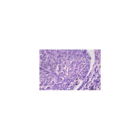 Basal cell carcinoma, showing pallisade cells and areas of melanin
