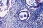 Onchocerca volvulus, sec. through host tissue with tumor containing larvae (filaria)