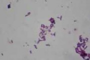 Helicobacter pylori, smear