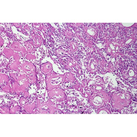 Osteoblast sarcoma