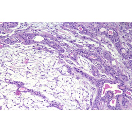 Acinic cell carcinoma