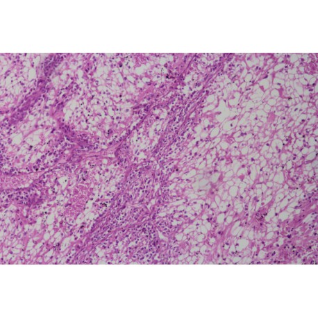 Nonspecific clear cell carcinoma