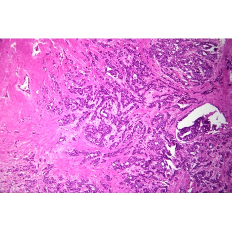 Adenoid cystic carcinoma, sec