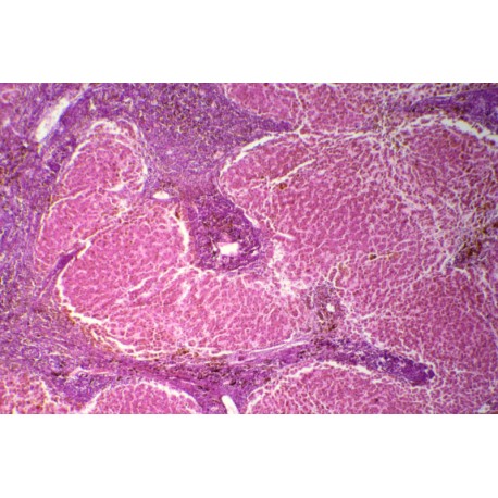 Pigmentary cirrhosis of liver