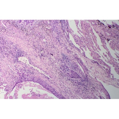 Lung squamous cell carcinoma , sec