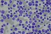 Chronic lymphocytic leukemia, blood smear