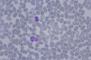 Acute monocytic leukemia, blood smear