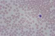Iron deficiency anemia, blood smear