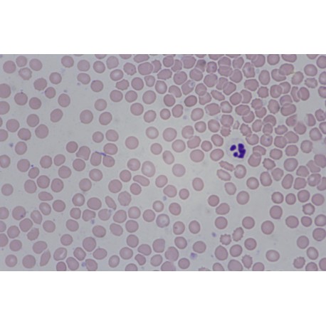 Iron deficiency anemia, blood smear