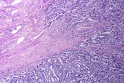Embryonal carcinoma of testis, sec