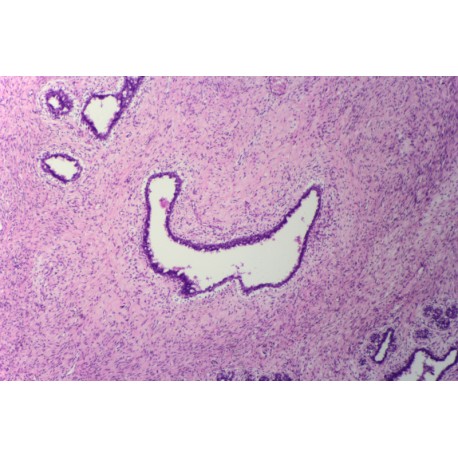 Ovarian serous cystadenoma, sec