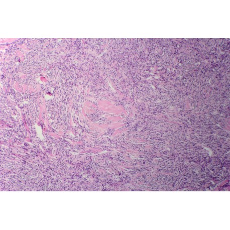 Theca cell tumor, sec