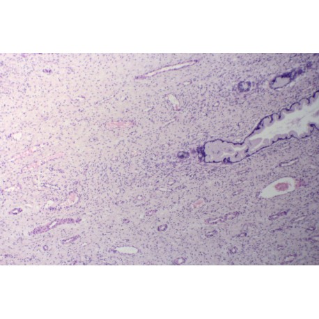 Chronic cervicitis, sec