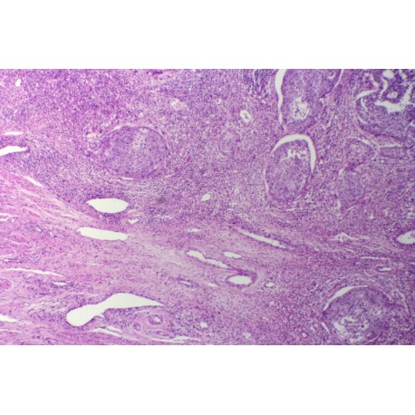 Cervical carcinoma in situ, sec