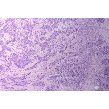 Breast Infiltrating ductal carcinoma, sec