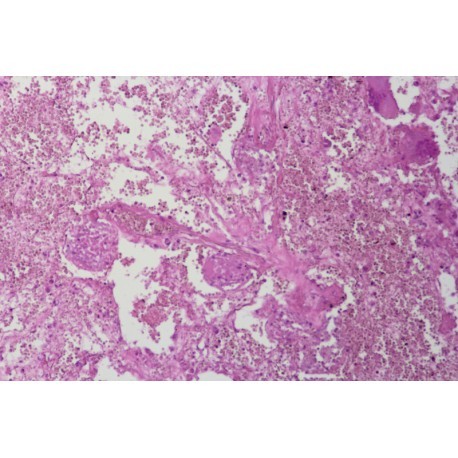 Bone giant cell carcinoma, sec