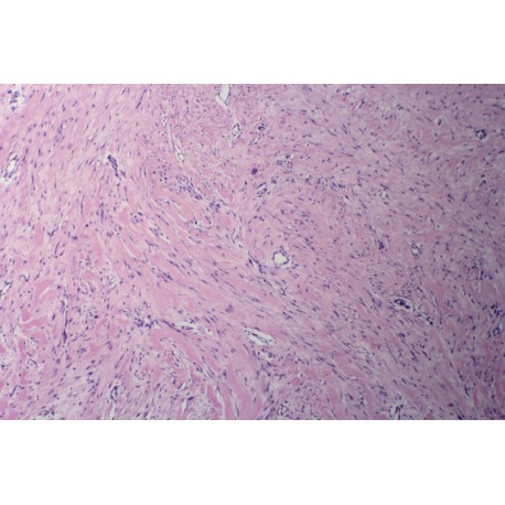 Amyloidosis (hyaline degeneration of connective tissue), sec