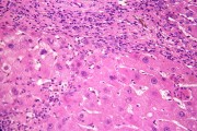Edema&nbsp;(liver cell edema),&nbsp;sec