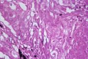 Squamous cell carcinoma of lung sec.