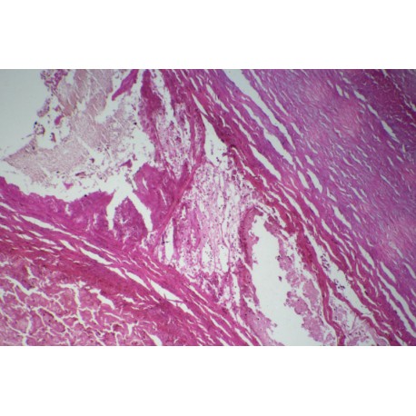 Fibrinoid necrosis of vascular wall sec.