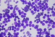 Megaloblastic anemia (peripheral blood)