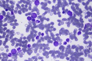 Hemolytic anemia (peripheral blood)