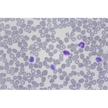 Acute lymphoma in leukemia (peripheral blood)