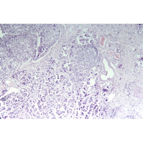 Transitional cell carcinoma of bladder (3rd-degree) sec.