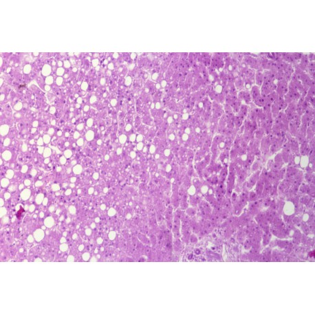 Human liver cell fatty degeneration sec.