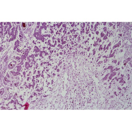 Necrosis of liver cells sec.