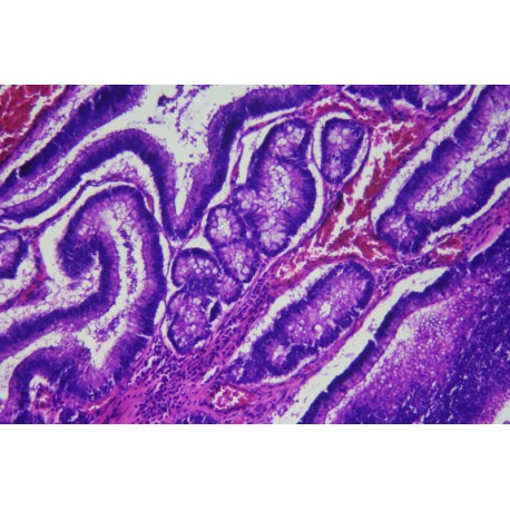 Polypous adenoma of intestine sec.