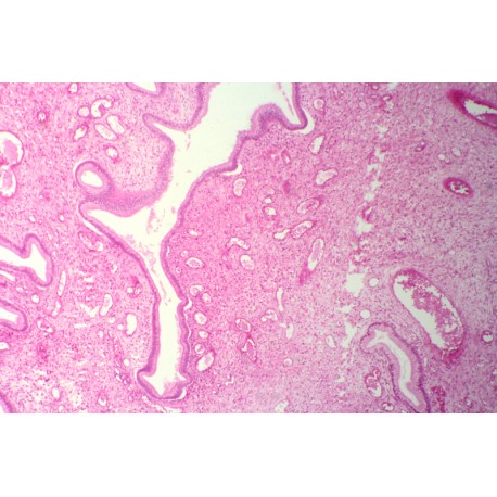 Squamous cell metaplasia of cervical mucosa sec.