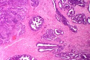 Mucous cystadenofibroma of ovary sec.