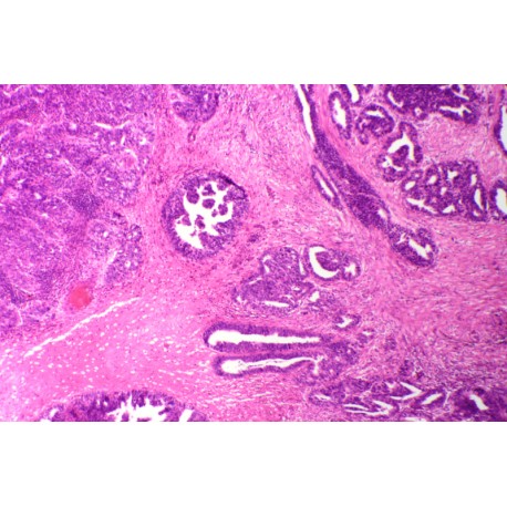 Mucous cystadenofibroma of ovary sec.