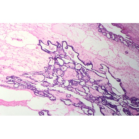 Papillary adenofibroma of ovary sec.