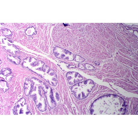 Hyperplasia of prostate, sec