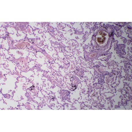 Alveolar carcinoma, sec