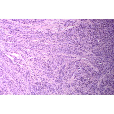 Uterine leiomyoma, sec