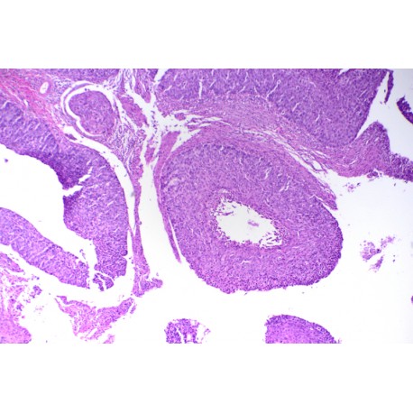 Cervix uteri squamous cell carcinoma.sec