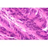 Cancer Slide Set