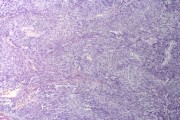 Sarcomatoid carcinoma sec.