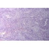 Sarcomatoid carcinoma sec.