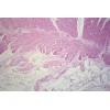 Well-differentiated adenocarcinoma of colon sec.